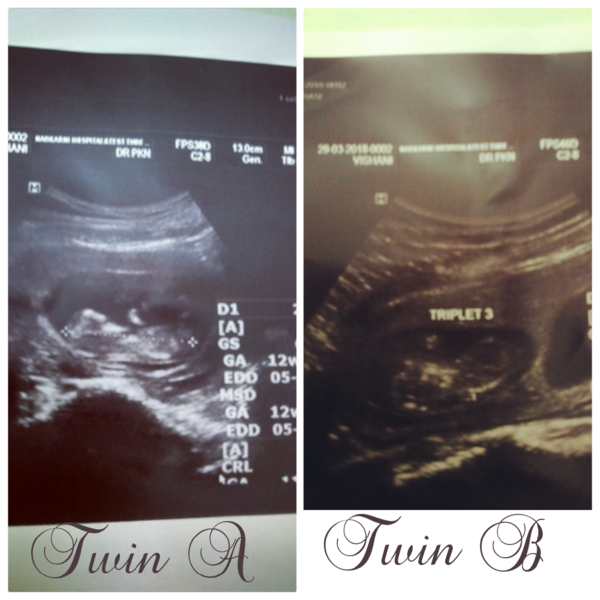 Nub theory guesses for twins