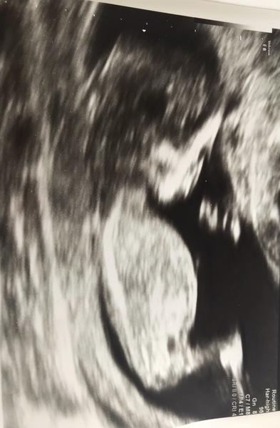 Nub theory- boy or girl?