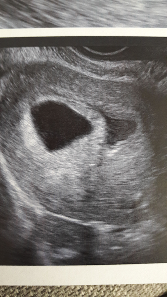 Gush of blood at 12 weeks? Terrified!