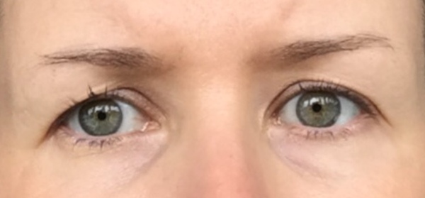 Update on my upper eyelid surgery and brow lift - 3 months down the line