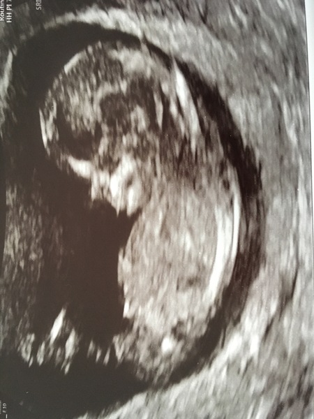 Gender guesses?? 12 week scan