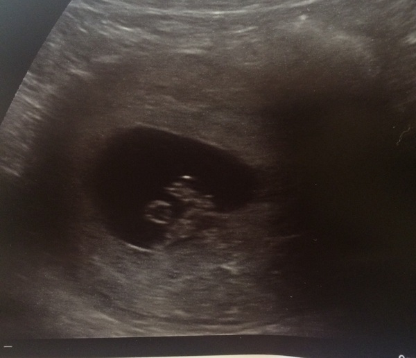 EPU scan tomorrow at 6+4