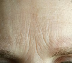 Forehead wrinkles