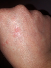 Anyone know what these blisters are on my hands?