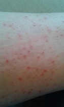 Ingrown hairs? :( :(
