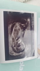 13 weeks scan pics-  anyone fancy a guess at the sex?