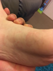 Spots on foot (pic included)