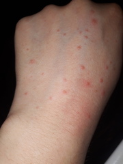 Anyone know what these blisters are on my hands?