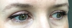 Update on my upper eyelid surgery and brow lift - 3 months down the line