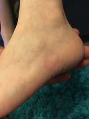 Spots on foot (pic included)