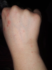 Anyone know what these blisters are on my hands?