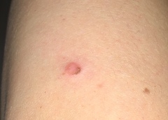 Sore mole going to make GP appt after easter