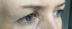 Update on my upper eyelid surgery and brow lift - 3 months down the line