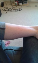 Ingrown hairs? :( :(