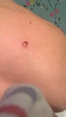 Sore mole going to make GP appt after easter