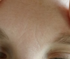 Forehead wrinkles
