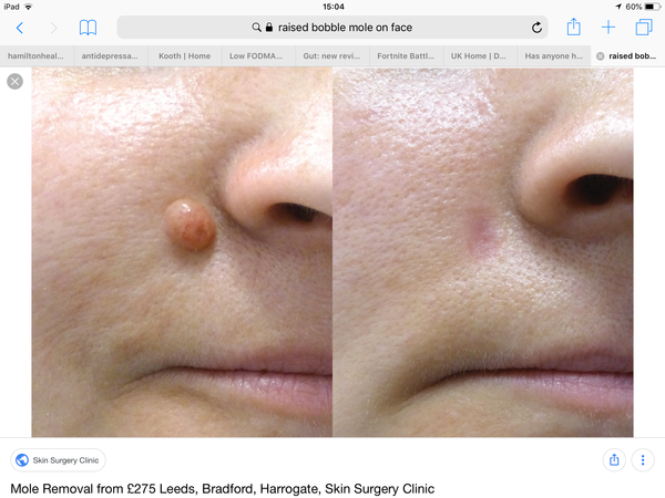 Has anyone had a mile removed from their face?