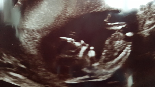 Nasal bone