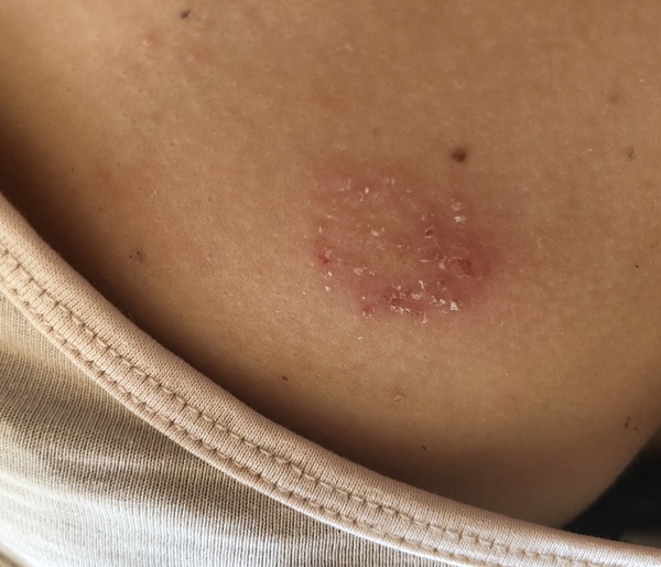 Oozing minor wounds (non gruesome photo)