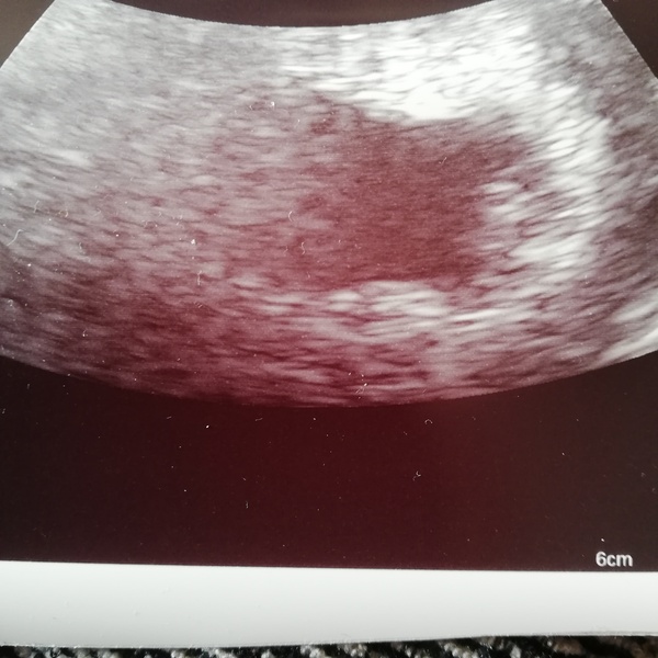 Early reassurance scan next Monday