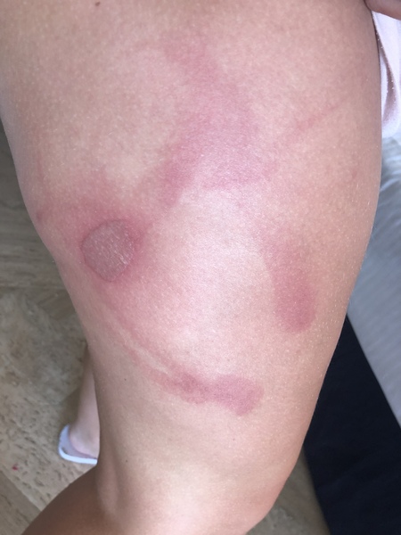 Brown spots - and leg burn. PIC included.