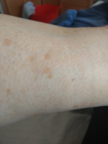 Patchy fake tan