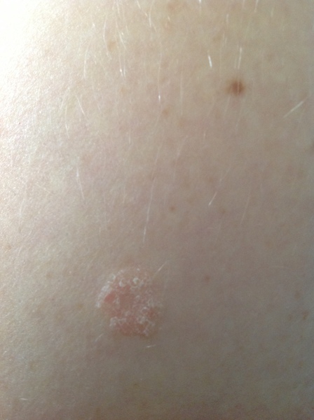 Is this ringworm?