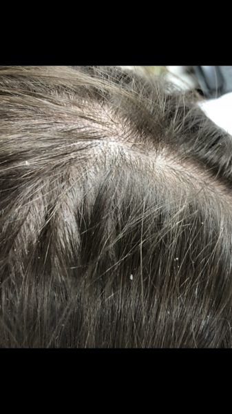 HELP!  I'm losing my hair!