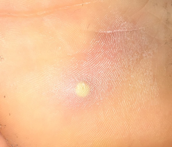 To ask what this is on my son's foot