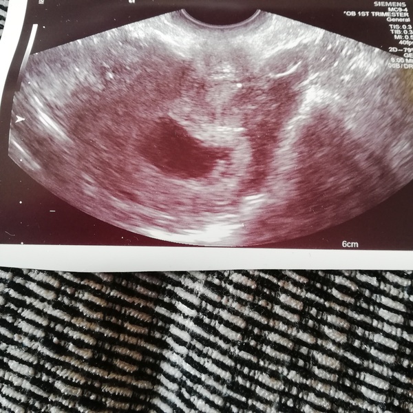 Update on early reassurance scan