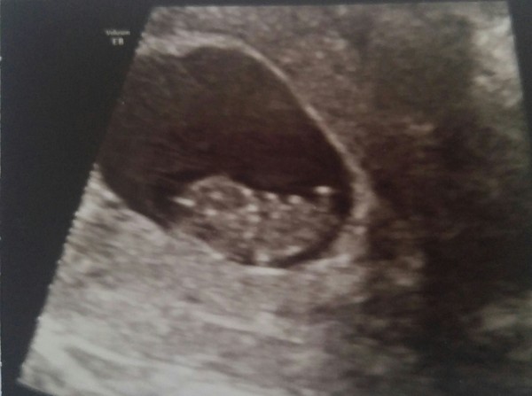 Fresh Start thread for pregnancy after miscarriage or loss