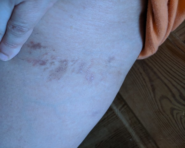 What the heck is this discolouration/rash?