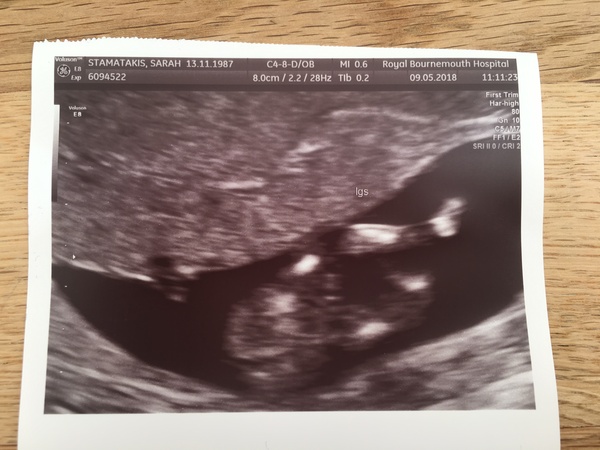 Guess the gender! 12 week scan
