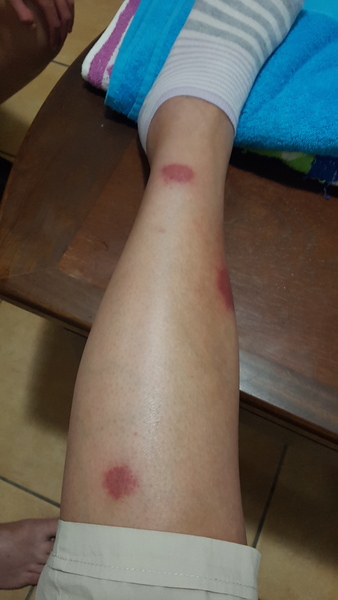 Want to see some good mozzie bites