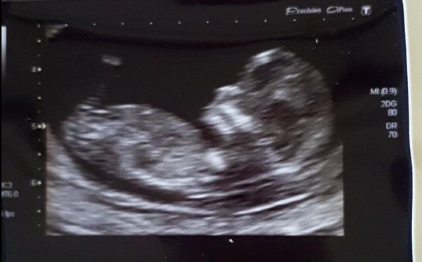 Due on 19th November! Boy or Girl😁