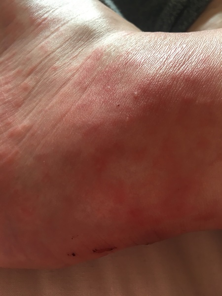 What could be the cause of this rash?