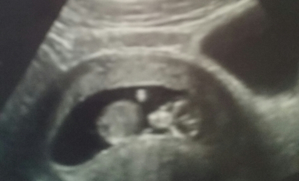 Obese and pregnant
