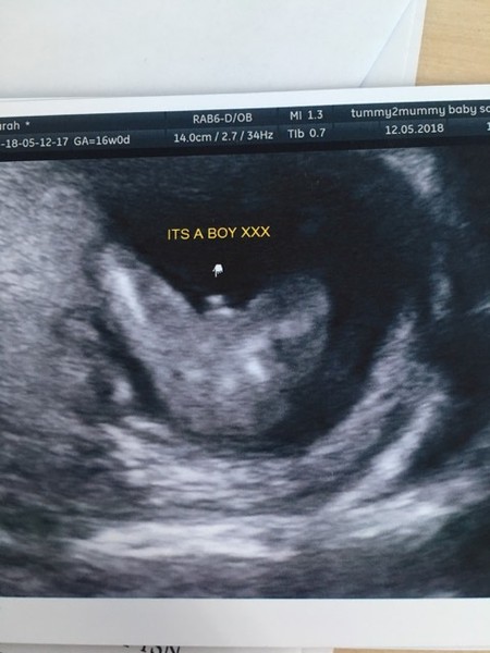 First scan pic! Nub theory?