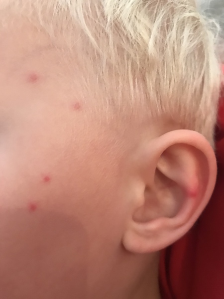 To ask your advice the chicken pox