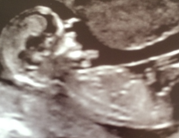 Downs screening. Can anyone help me?