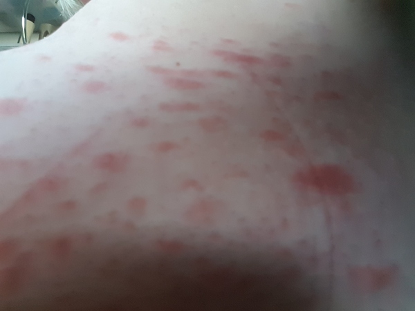 To ask what this bloody rash is?