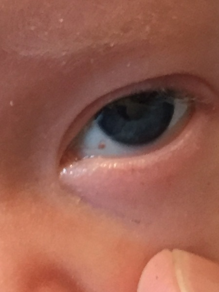 Burst blood vessel 7 week old baby