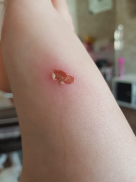 Aibu to think this is becoming infected
