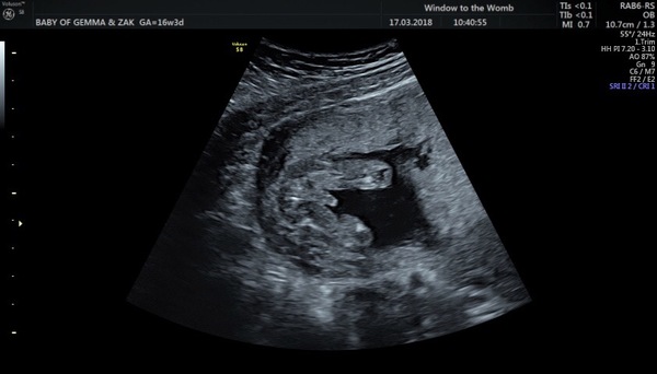 Opinions on accuracy of my gender scan :-)