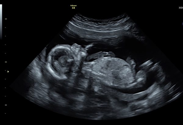 Boy or girl