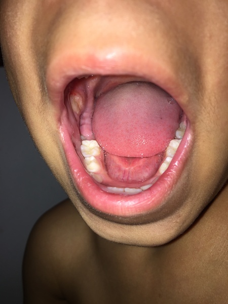 Mouth ulcer? Warning: pic