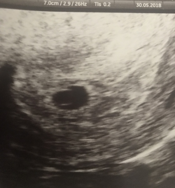 Looking for reassurance (early scan)