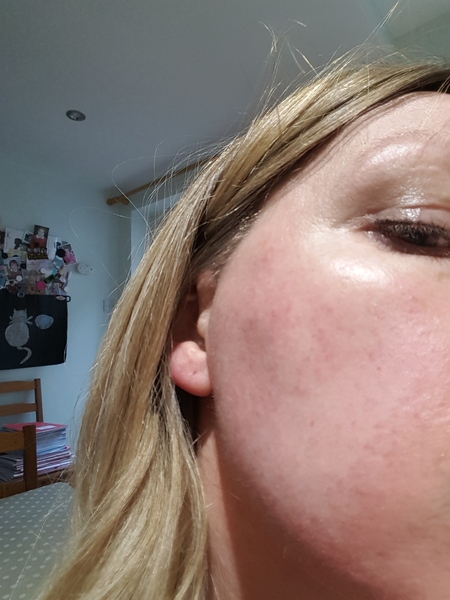 Does lasering red veins work or is there another way?