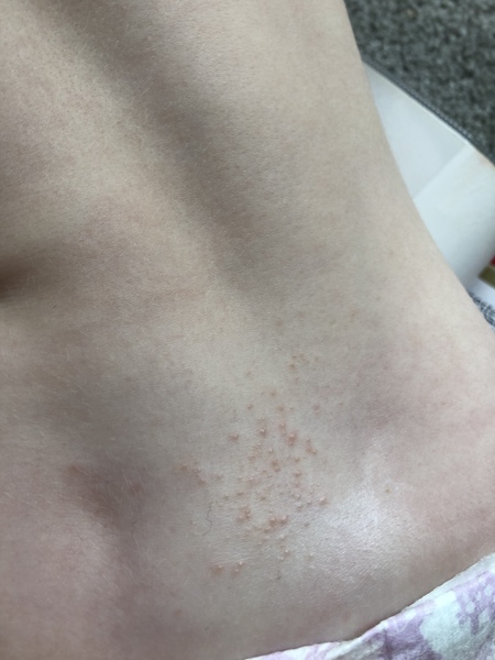 Rash