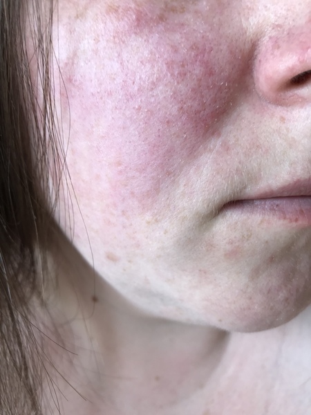 What can I do about my skin tone?